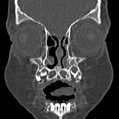Choanal atresia (Radiopaedia 88525-105975 Coronal bone window 7).jpg