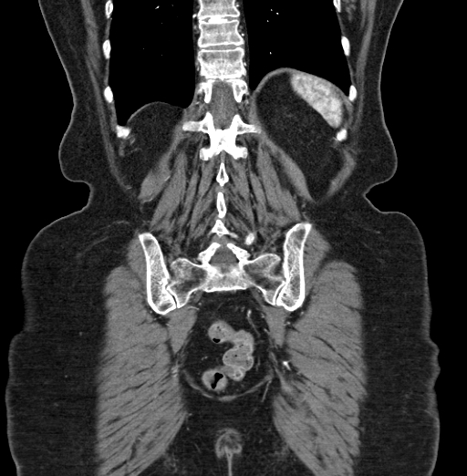 File:Cholecystoduodenal fistula due to calculous cholecystitis with gallstone migration (Radiopaedia 86875-103077 B 38).jpg