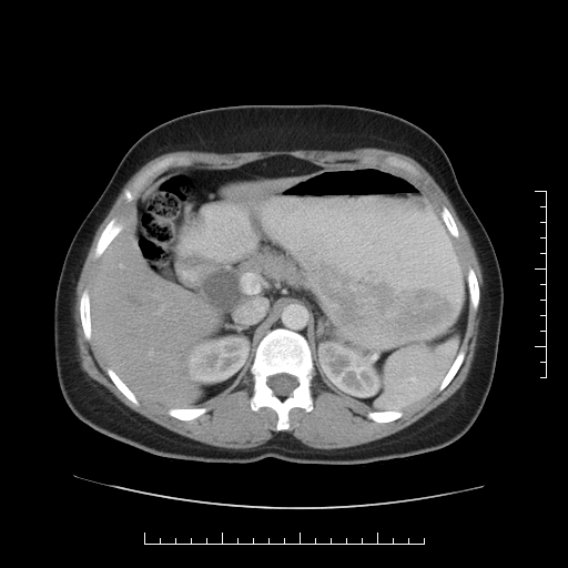 File:Choledochal cyst with chronic calcific pancreatitis (Radiopaedia 18245-18061 A 8).png