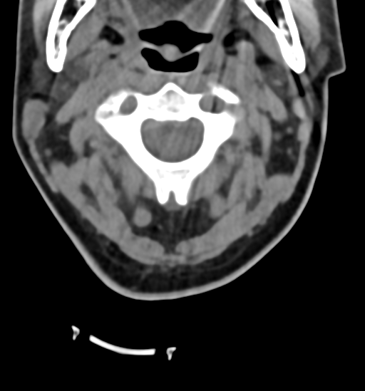 File:Chordoma (C4 vertebra) (Radiopaedia 47561-52188 Axial non-contrast 14).png