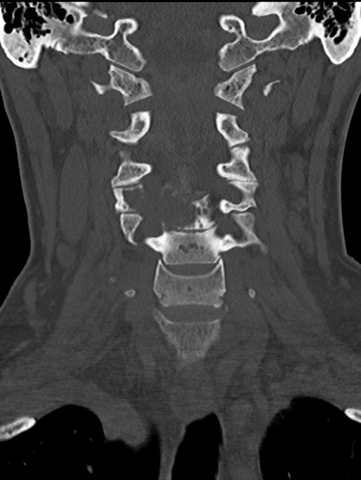 Chordoma (C4 vertebra) (Radiopaedia 47561-52188 Coronal bone window 21).png
