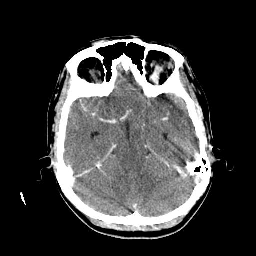 File:Choriocarcinoma of ovary with cerebral and pulmonary metastases (Radiopaedia 25983-26118 C+ arterial phase 52).jpg