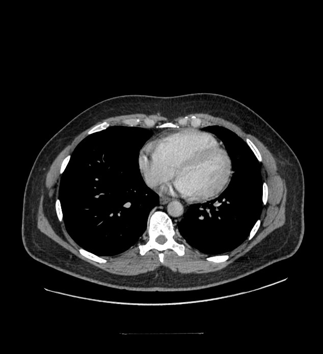 Chromophobe renal cell carcinoma (Radiopaedia 84337-99644 C 2).jpg