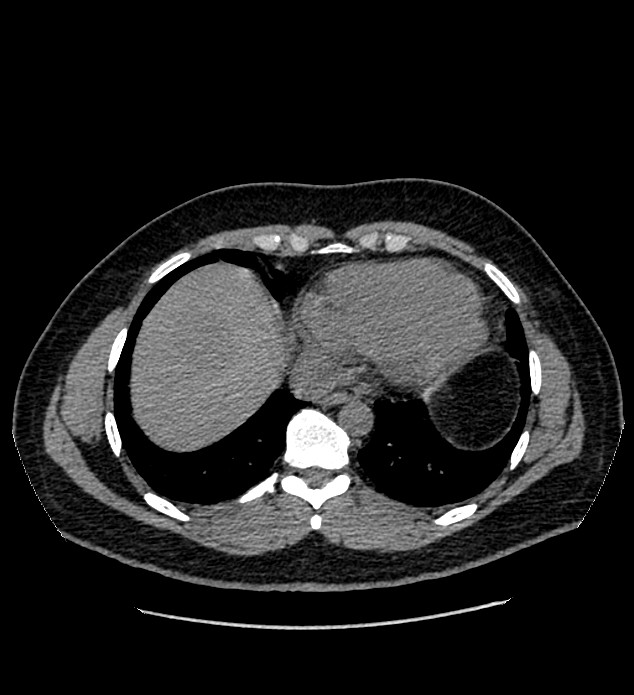 Chromophobe renal cell carcinoma (Radiopaedia 84337-99693 Axial non-contrast 1).jpg