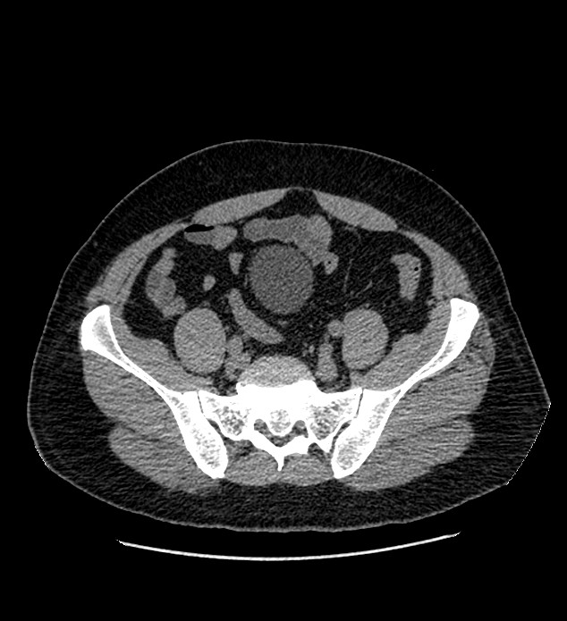 Chromophobe renal cell carcinoma (Radiopaedia 84337-99693 Axial non-contrast 119).jpg