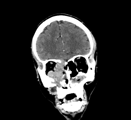 Chronic invasive fungal sinusitis with intraorbital and intracranial extension (Radiopaedia 56387-63046 C 102).jpg