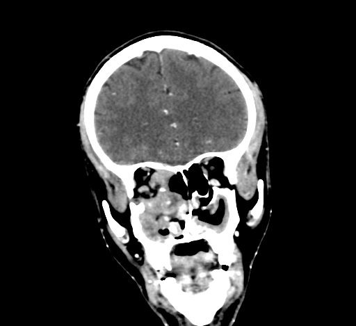 Chronic invasive fungal sinusitis with intraorbital and intracranial extension (Radiopaedia 56387-63046 C 118).jpg