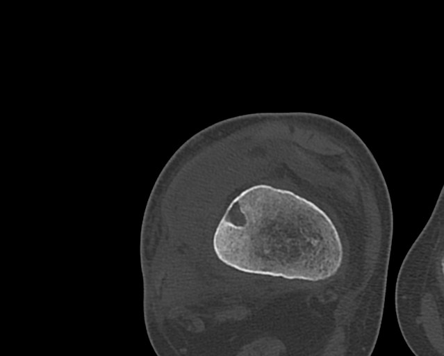 Chronic ostemyelitis of the femur with long sinus tract (Radiopaedia 74947-85982 Axial bone window 201).jpg