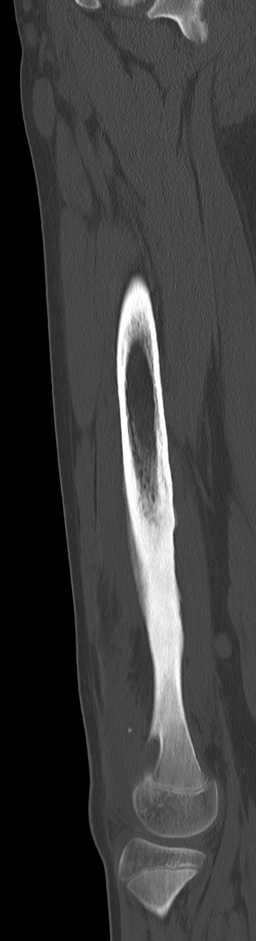 Chronic ostemyelitis of the femur with long sinus tract (Radiopaedia 74947-85982 Sagittal bone window 45).jpg