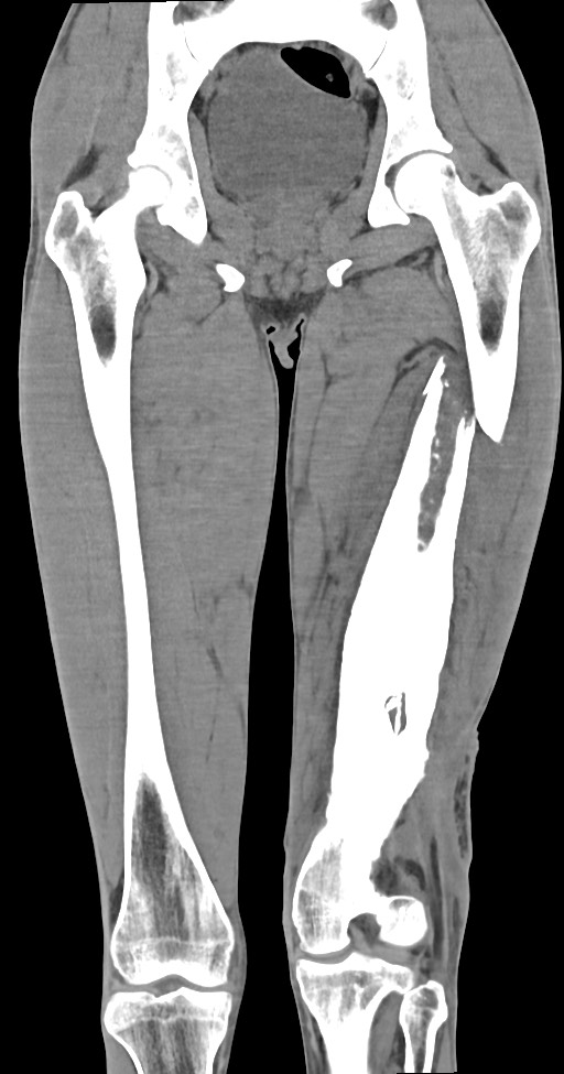Chronic osteomyelitis (with sequestrum) (Radiopaedia 74813-85822 E 31).jpg