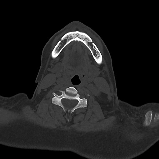 Chronic osteomyelitis - calvarial (severe) (Radiopaedia 69668-79616 Axial bone window 2).jpg