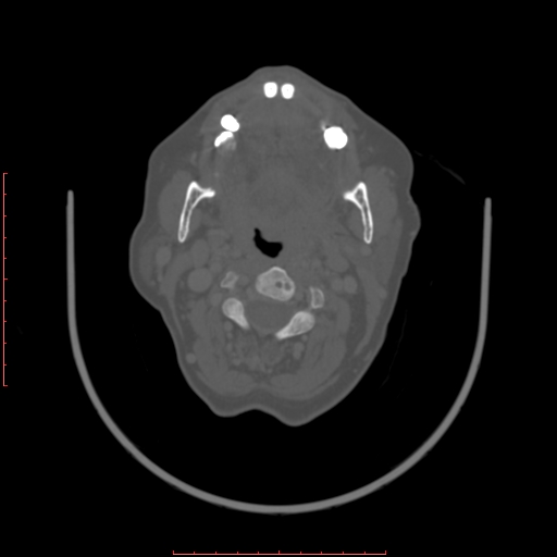 File:Chronic osteomyelitis - maxilla (Radiopaedia 23783-23927 Axial bone window 53).jpg