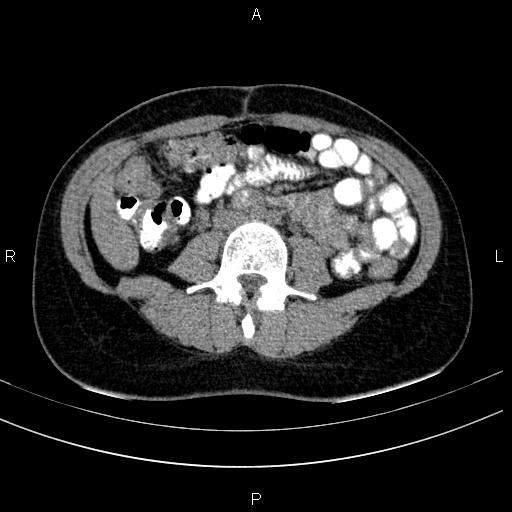 Chronic pancreatitis (Radiopaedia 64576-73450 Axial non-contrast 91).jpg