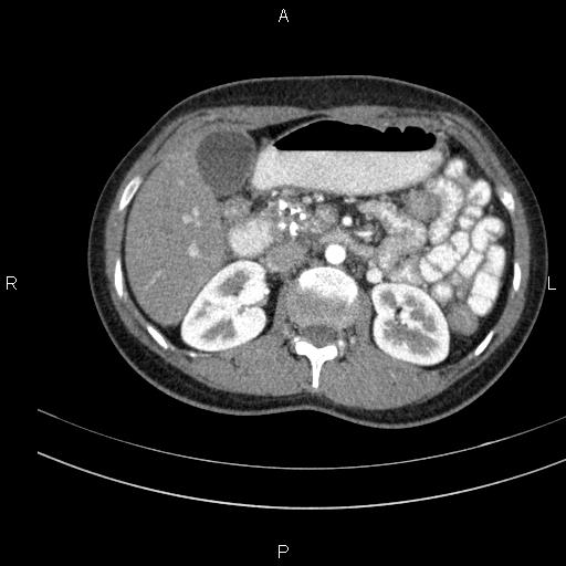 File:Chronic pancreatitis (Radiopaedia 64576-73450 B 59).jpg