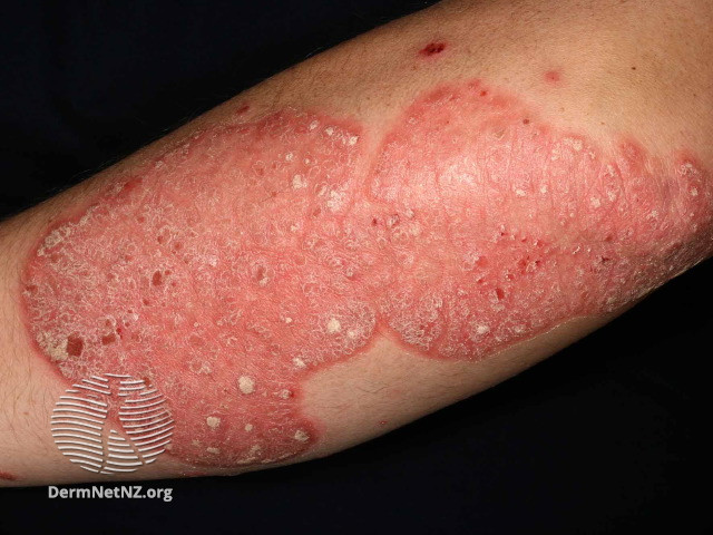 File:Chronic plaque psoriasis (DermNet NZ psorvulg1).jpg