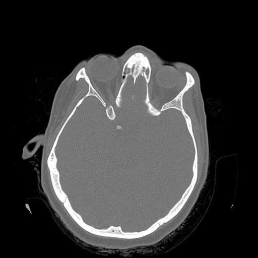 File:Chronic sinusitis with intra-sinus calcification (Radiopaedia 63919-72668 Axial bone window 3).jpg