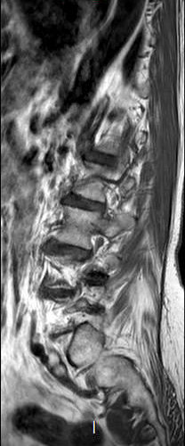 File:Chronic spinal hematoma with cauda equina syndrome (Radiopaedia 75745-87090 Sagittal T1 3).png