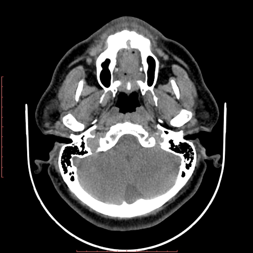 File:Chronic submandibular sialolithiasis (Radiopaedia 69817-79814 Axial non-contrast 24).jpg