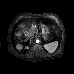 Cirrhosis and hepatocellular carcinoma in the setting of hemochromatosis (Radiopaedia 75394-86594 Axial T1 C+ fat sat 136).jpg