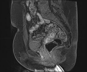 File:Class II Mullerian duct anomaly- unicornuate uterus with rudimentary horn and non-communicating cavity (Radiopaedia 39441-41755 G 57).jpg