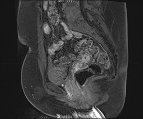 File:Class II Mullerian duct anomaly- unicornuate uterus with rudimentary horn and non-communicating cavity (Radiopaedia 39441-41755 G 58).jpg
