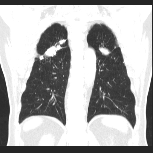 File:Classic complicated silicosis (Radiopaedia 49720-54961 Coronal lung window 46).jpg