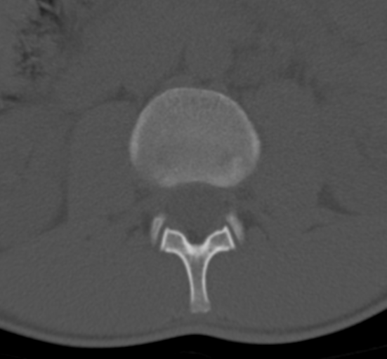 Clear cell meningoma - lumbar spine (Radiopaedia 60116-67691 Axial bone window 22).png