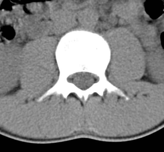 File:Clear cell meningoma - lumbar spine (Radiopaedia 60116-67691 Axial non-contrast 28).png