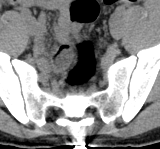 File:Clear cell meningoma - lumbar spine (Radiopaedia 60116-67691 Axial non-contrast 78).png