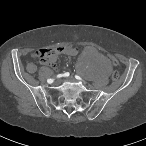 File:Clear cell renal cell carcinoma (Radiopaedia 28270-28505 A 34).jpg