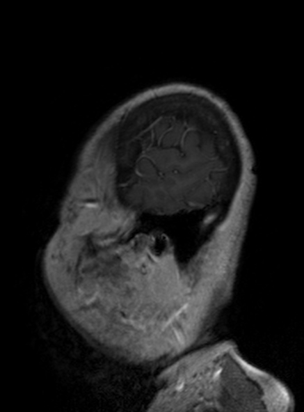Clival meningioma (Radiopaedia 53278-59248 Sagittal T1 C+ 142).jpg