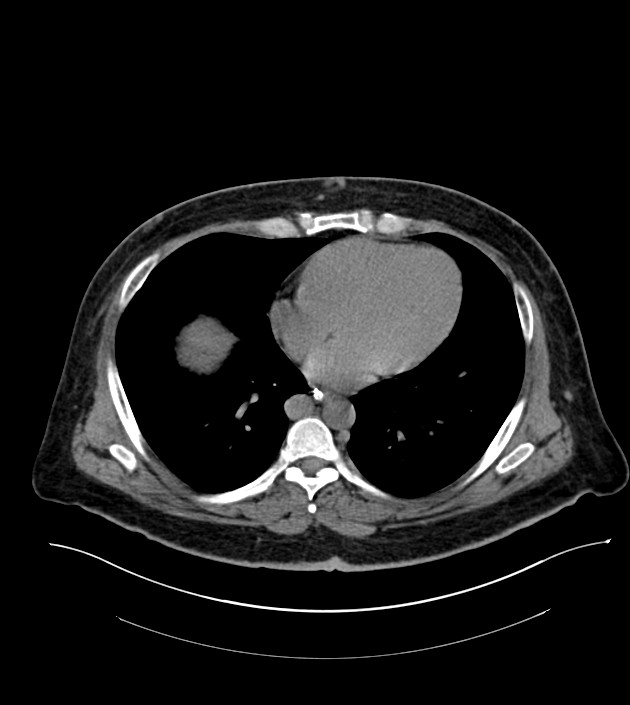 Closed-loop small bowel obstruction-internal hernia (Radiopaedia 78439-91096 Axial non-contrast 8).jpg