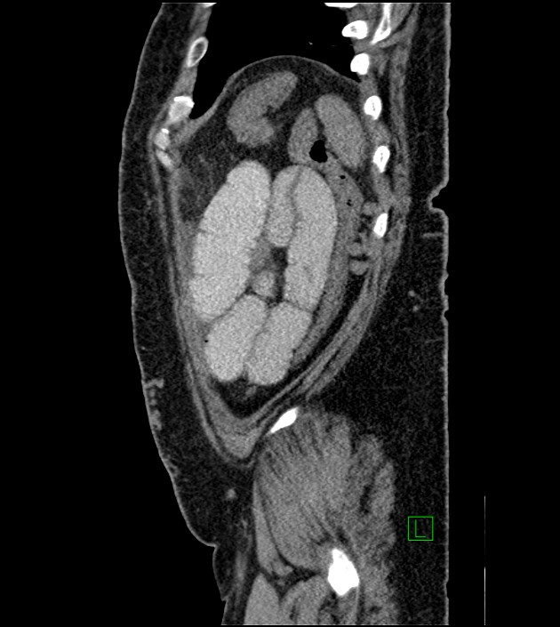 Closed-loop small bowel obstruction-internal hernia (Radiopaedia 78439-91096 C 28).jpg