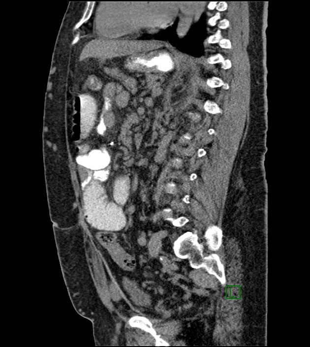Closed-loop small bowel obstruction-internal hernia (Radiopaedia 78439-91096 C 67).jpg