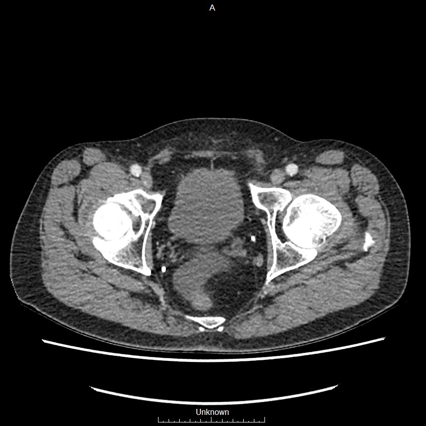 Closed loop bowel obstruction and ischemia (Radiopaedia 86959-103180 A 83).jpg