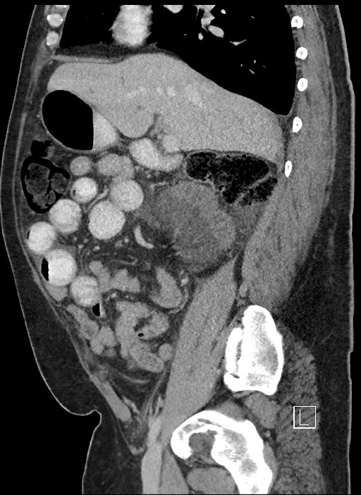Closed loop obstruction - internal hernia into nephrectomy bed (Radiopaedia 59867-67320 C 64).jpg