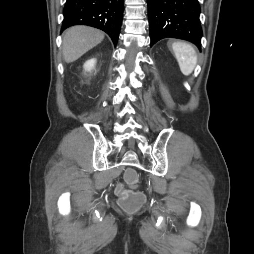 Closed loop obstruction due to adhesive band, resulting in small bowel ischemia and resection (Radiopaedia 83835-99023 C 98).jpg