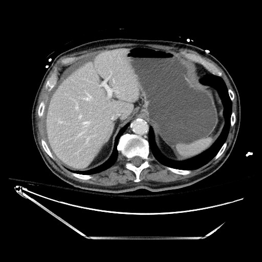 File:Closed loop obstruction due to adhesive band, resulting in small bowel ischemia and resection (Radiopaedia 83835-99023 D 35).jpg