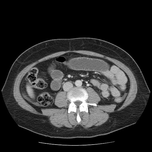 File:Closed loop small bowel obstruction (Radiopaedia 65403-74451 A 44).jpg