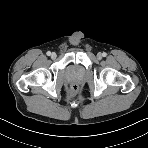 Closed loop small bowel obstruction - internal hernia (Radiopaedia 57806-64778 B 126).jpg