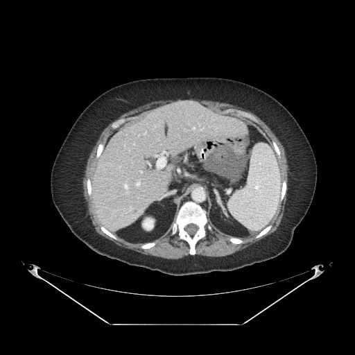 Closed loop small bowel obstruction - internal hernia (Radiopaedia 65402-74450 A 28).jpg