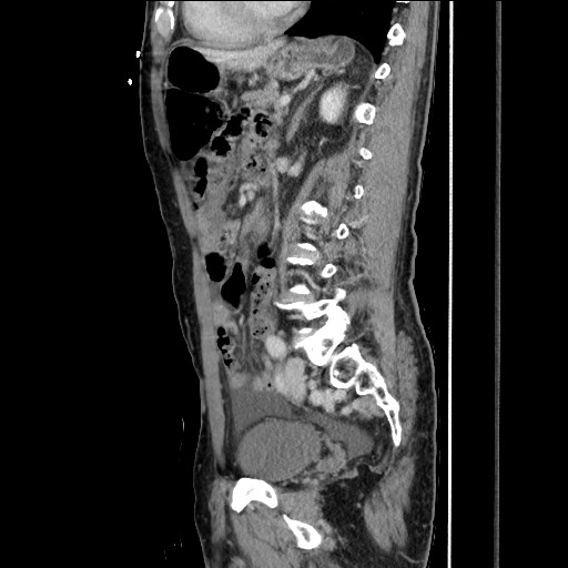 Closed loop small bowel obstruction - omental adhesion causing "internal hernia" (Radiopaedia 85129-100682 C 110).jpg