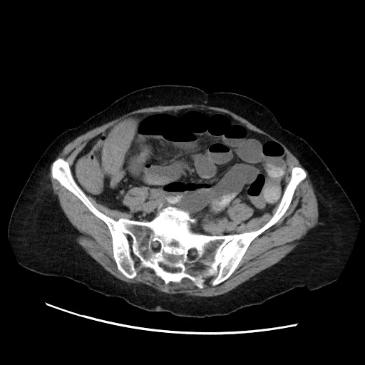File:Closed loop small bowel obstruction due to adhesive band, with intramural hemorrhage and ischemia (Radiopaedia 83831-99017 Axial non-contrast 113).jpg