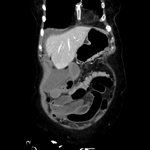Closed loop small bowel obstruction due to adhesive band, with intramural hemorrhage and ischemia (Radiopaedia 83831-99017 C 30).jpg