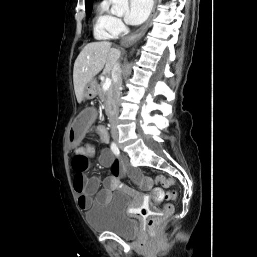 Closed loop small bowel obstruction due to adhesive band, with intramural hemorrhage and ischemia (Radiopaedia 83831-99017 D 101).jpg