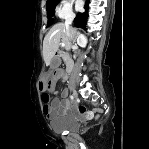 Closed loop small bowel obstruction due to adhesive band, with intramural hemorrhage and ischemia (Radiopaedia 83831-99017 D 89).jpg