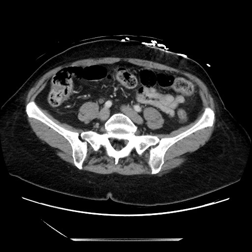 Closed loop small bowel obstruction due to adhesive bands - early and late images (Radiopaedia 83830-99014 A 102).jpg