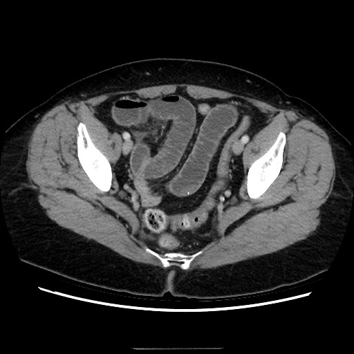 Closed loop small bowel obstruction due to adhesive bands - early and late images (Radiopaedia 83830-99015 A 143).jpg