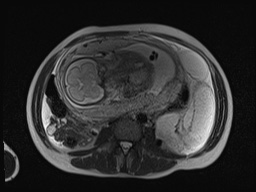 File:Closed loop small bowel obstruction in pregnancy (MRI) (Radiopaedia 87637-104031 Axial T2 41).jpg