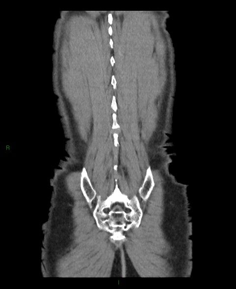 Closed loop small bowel obstruction with ischemia (Radiopaedia 84180-99456 B 3).jpg